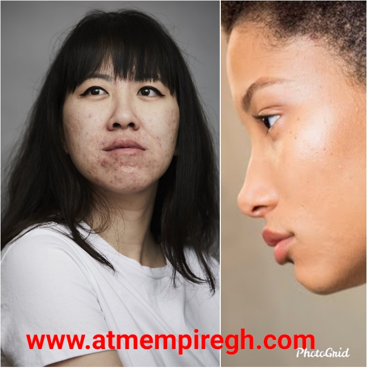 Best way to treat pimples from your face. Medical&nbsp;Advise.