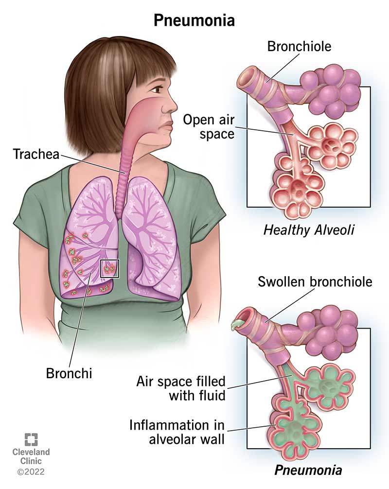 COVID-19 ; Fungal Pneumonia, Caused And&nbsp;Treatment